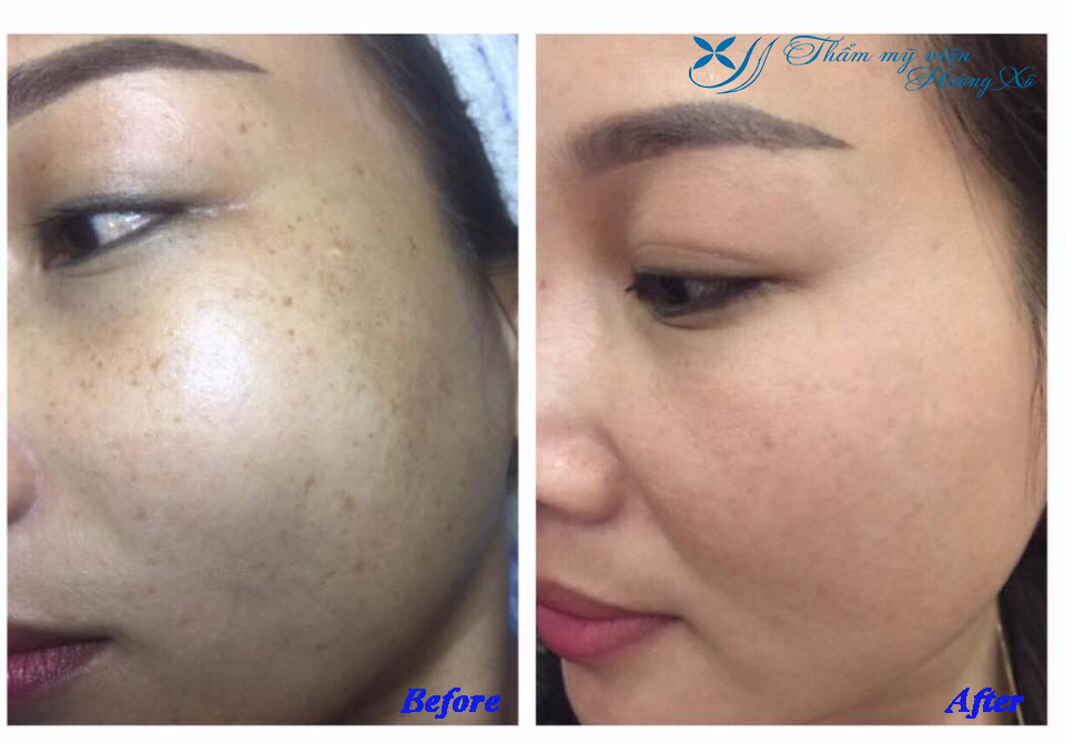 Điều trị nám tàn nhang tại Vinh Nghệ An