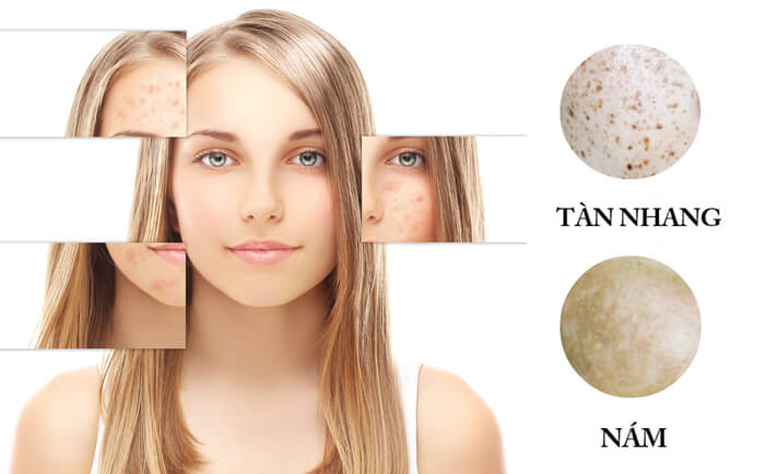 Điều trị nám tàn nhang tại Vinh Nghệ An