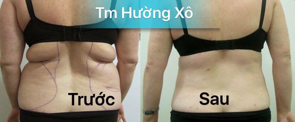 Đánh tan mỡ bụng tại Vinh Nghệ An