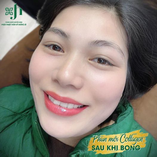 phun môi collagen tại vinh, nghệ an