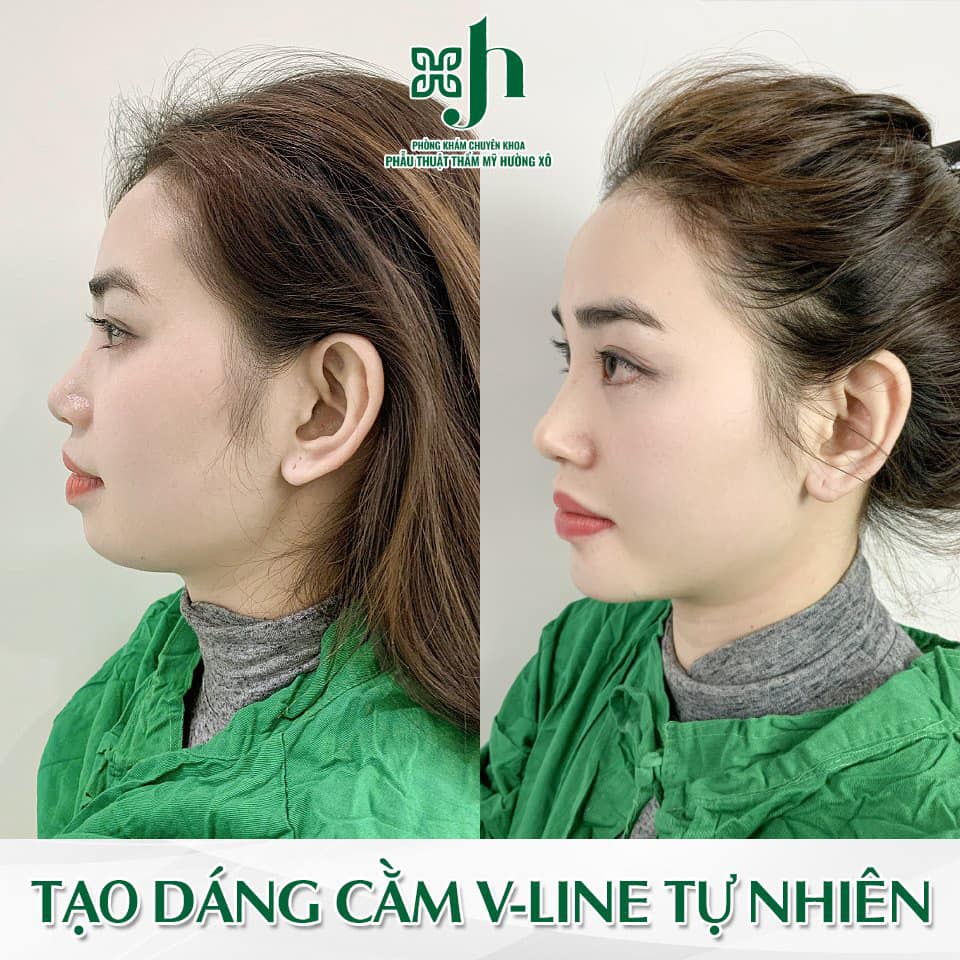 Độn cằm V-Line