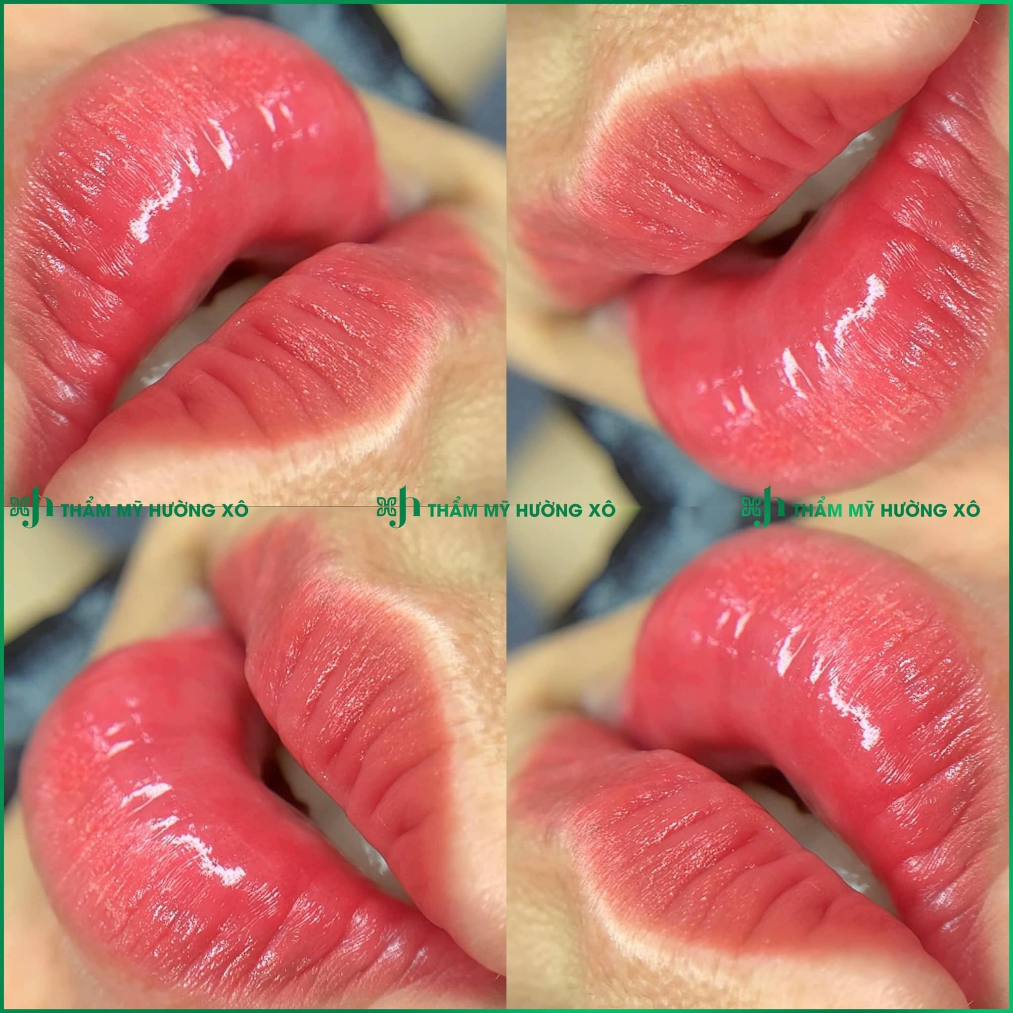 Phun môi collagen