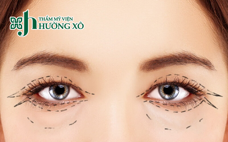 Thẩm mỹ mắt 