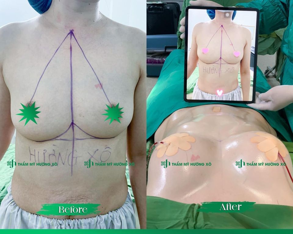 Nâng ngực không chạm