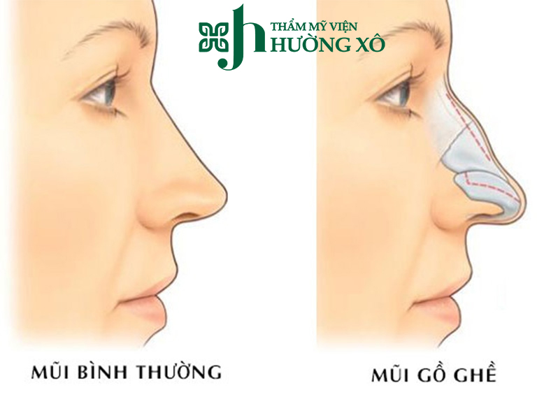 Mài gồ mũi