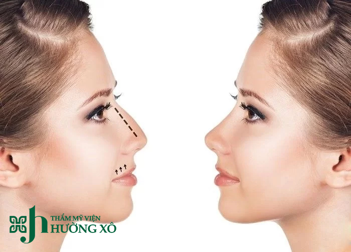 Dịch vụ mài gồ xương mũi