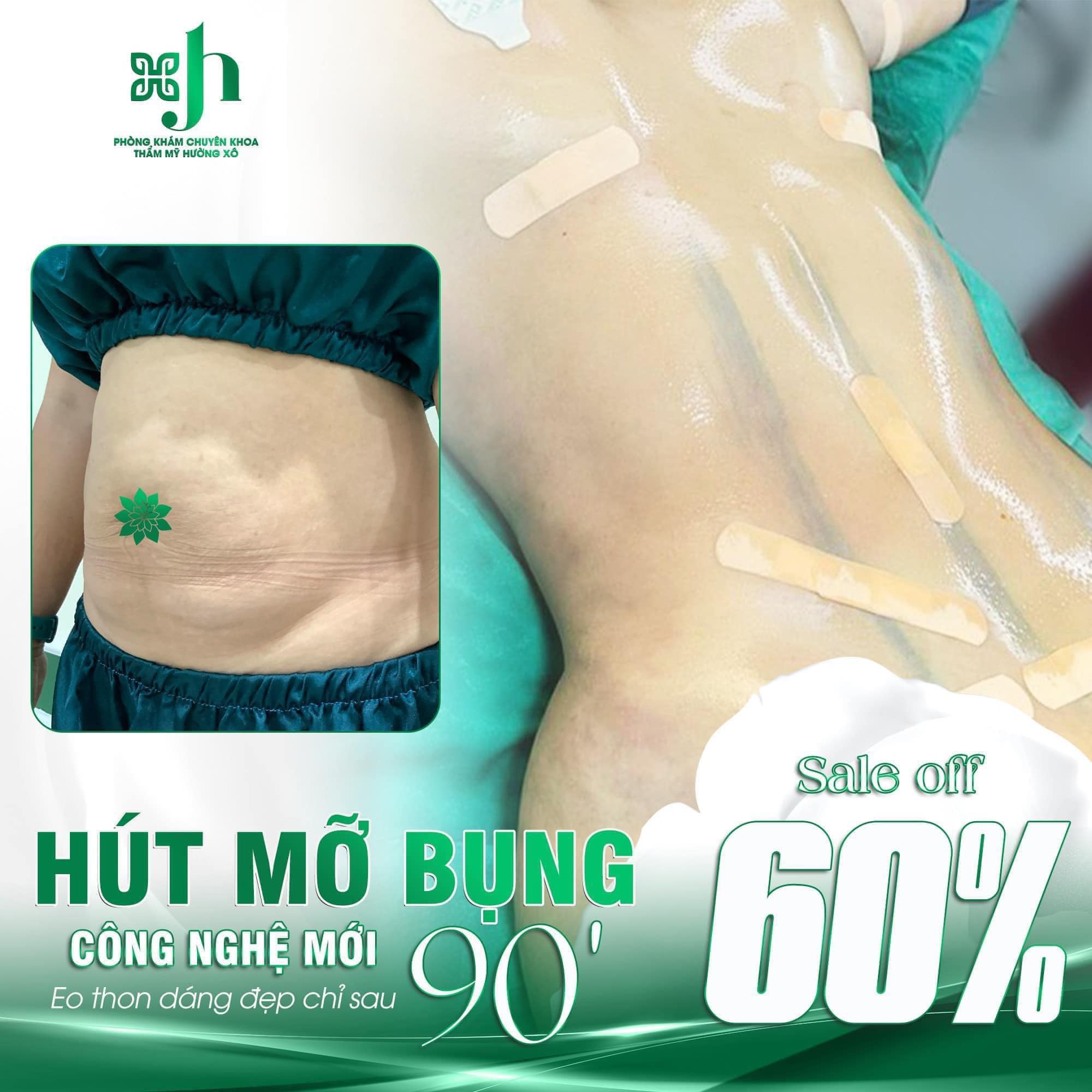 Hút mỡ bụng