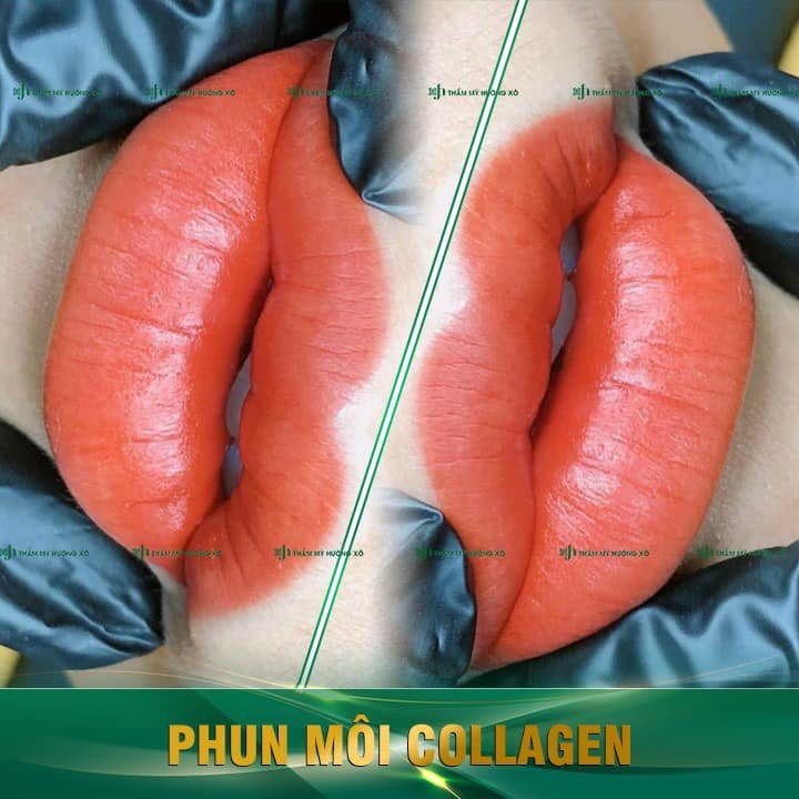Phun môi collagen