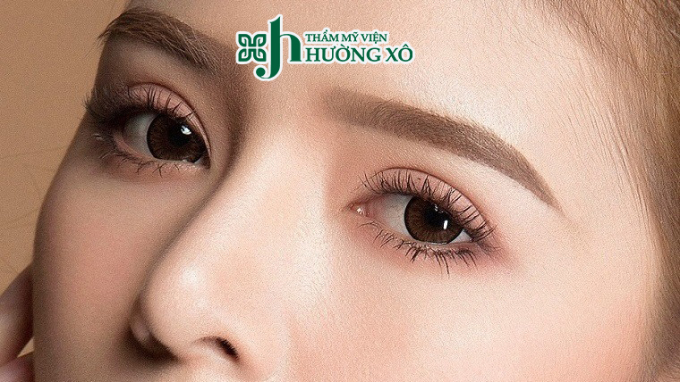 Cắt mí nội soi