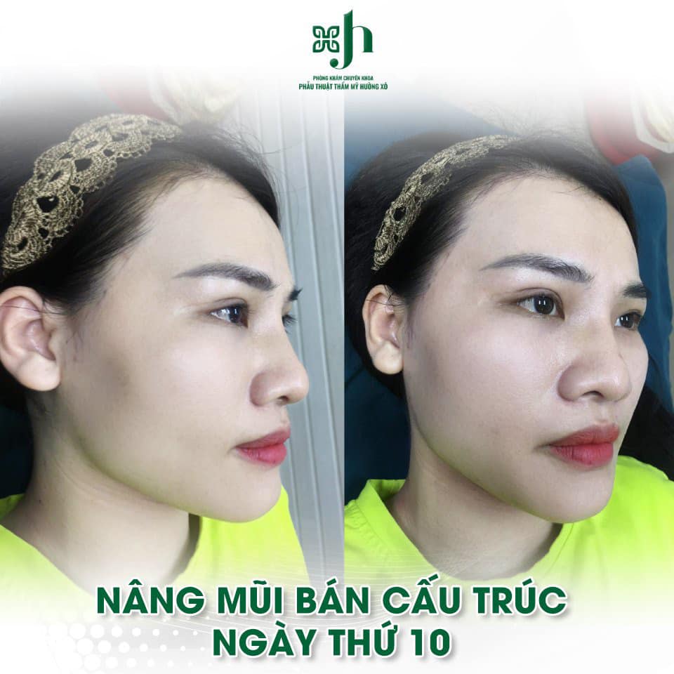 Nâng mũi bán cấu trúc