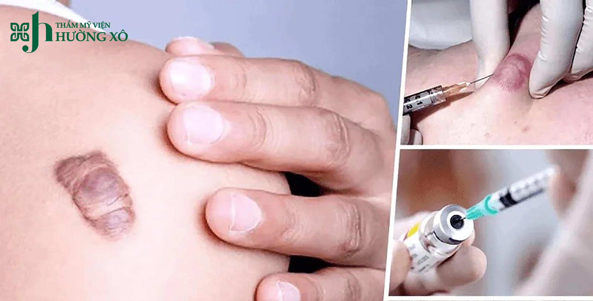 Tiêm sẹo lồi