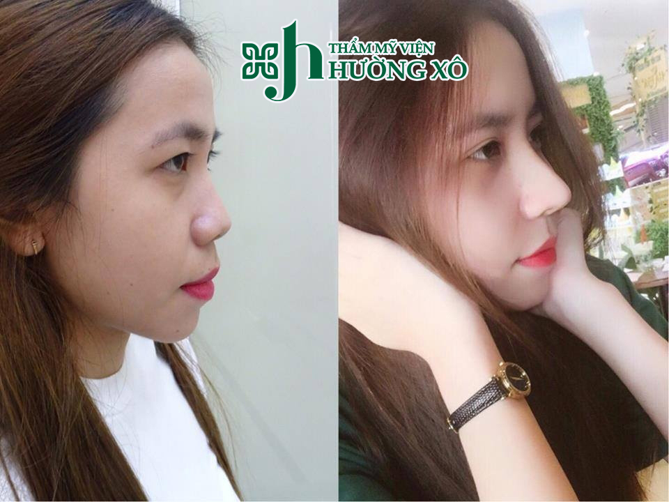 Nâng mũi Hàn Quốc