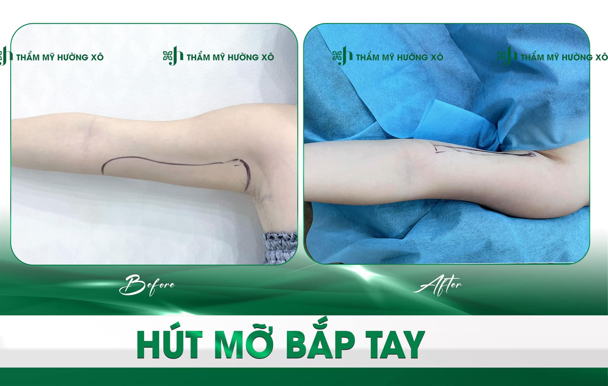 Hút mỡ