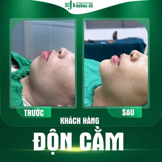 Dịch vụ độn cằm