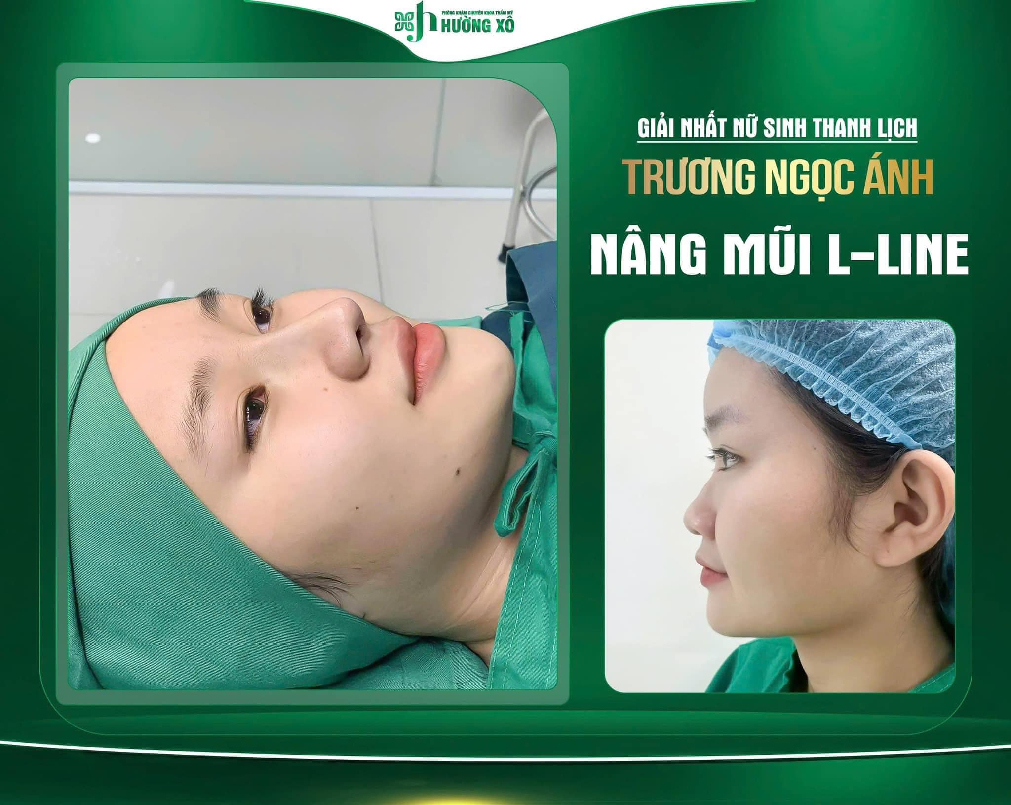 Nâng mũi L Line