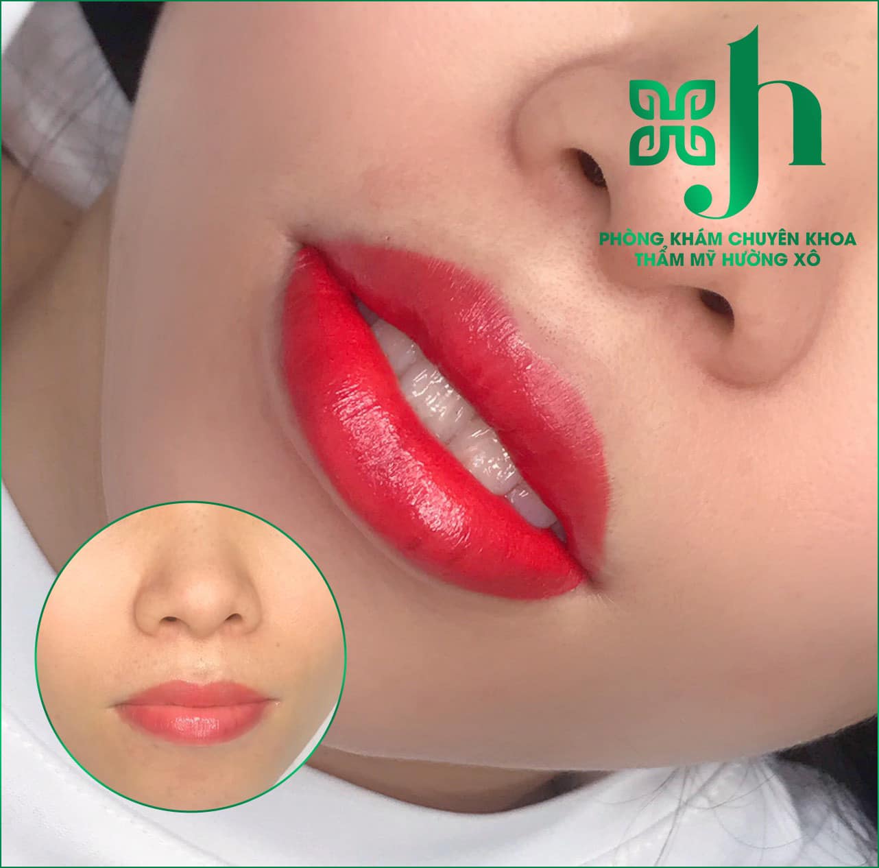 Phun môi collagen