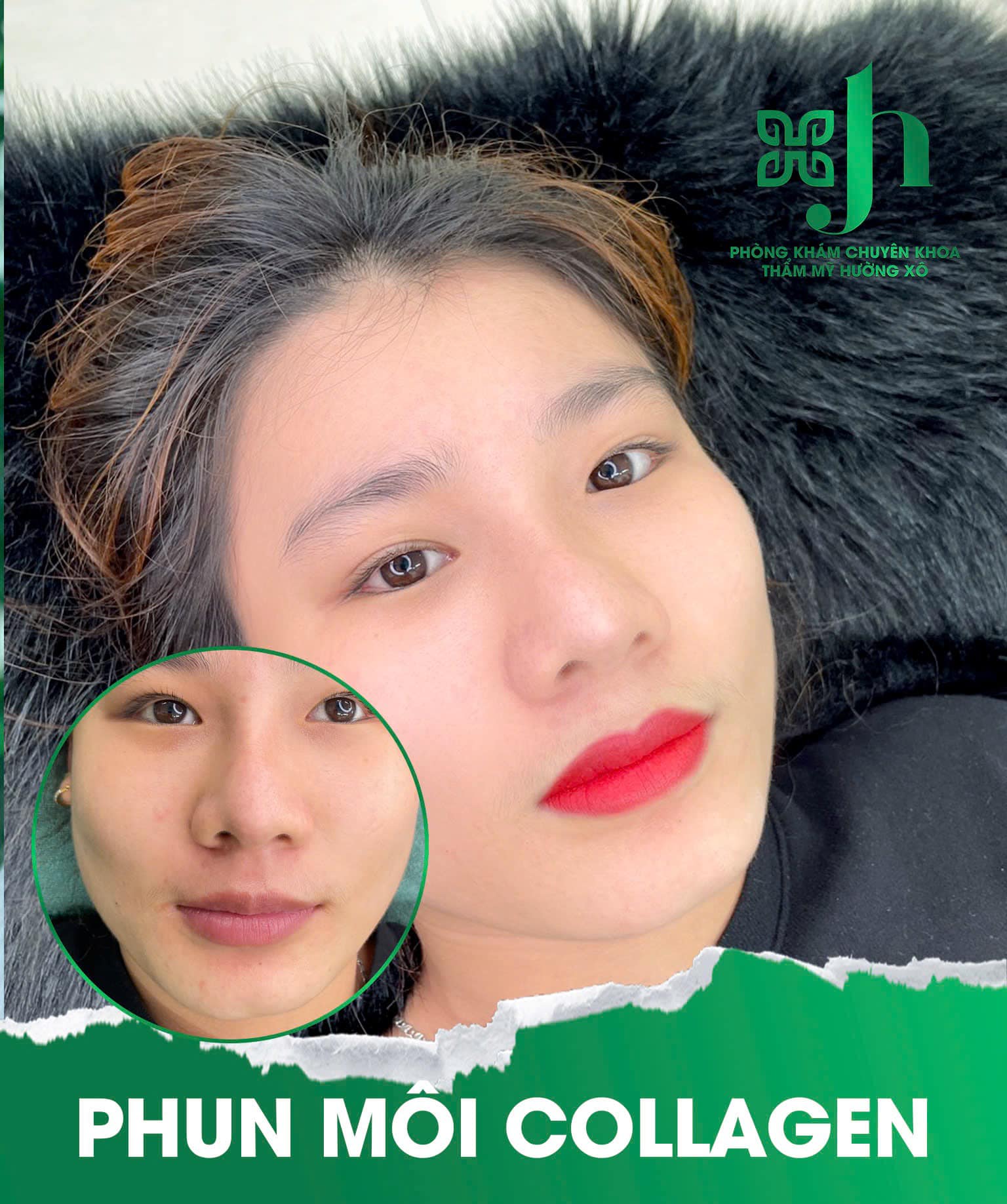 Phun môi collagen