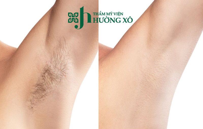 Triệt lông nách