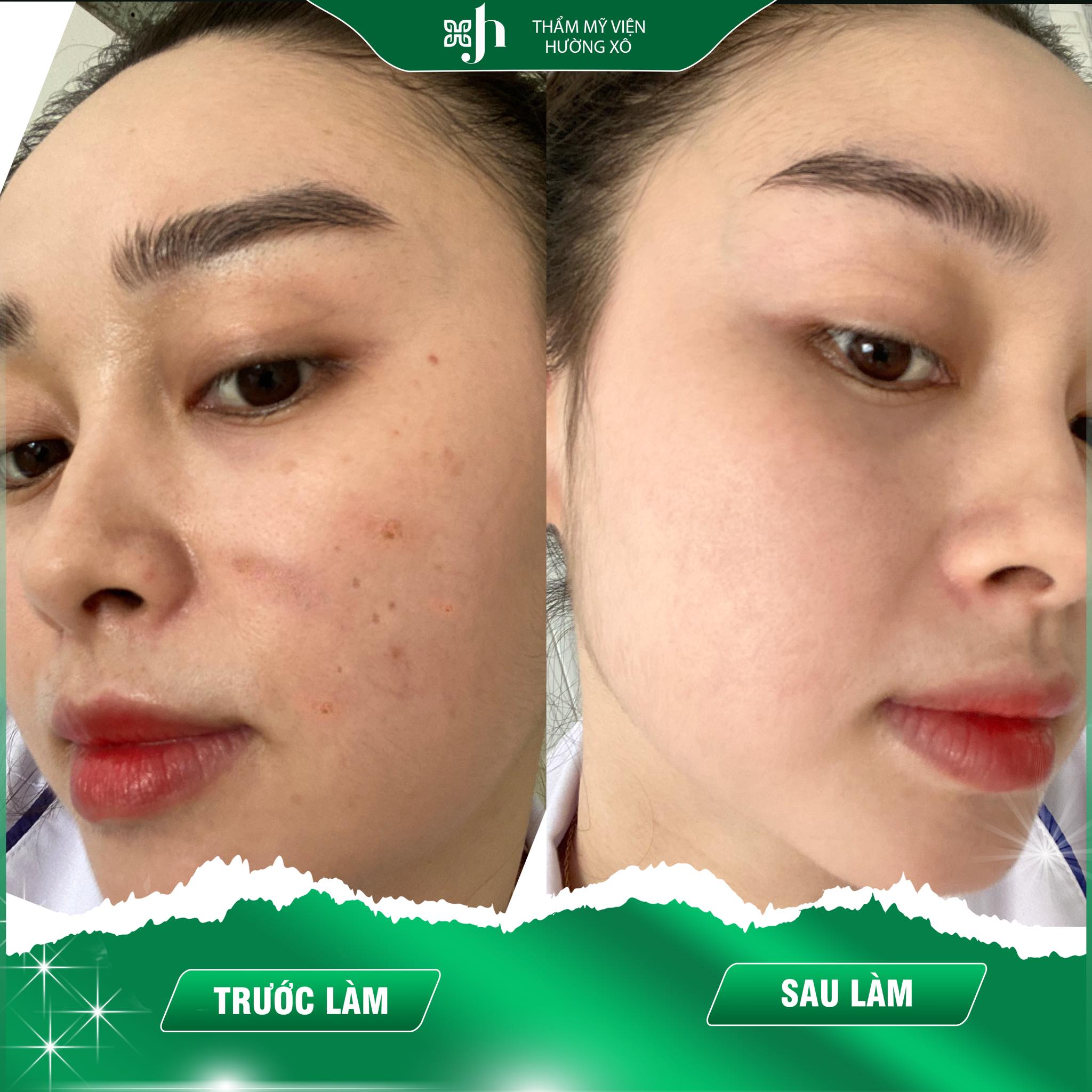 Trị thâm mụn