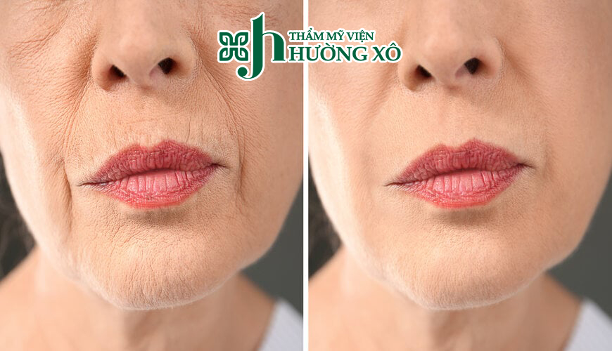 Trẻ hoá da mặt