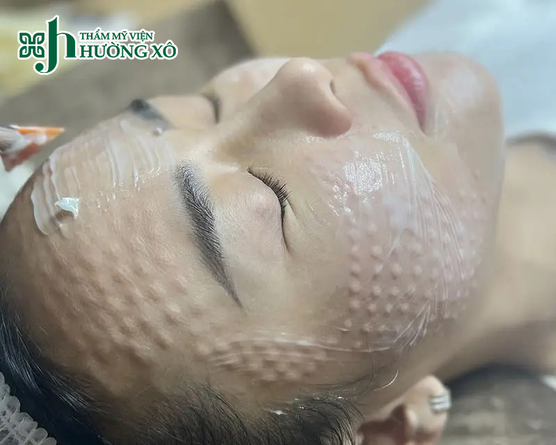 Tiêm Meso căng bóng da