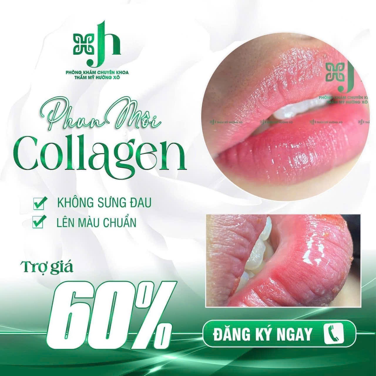 Phun môi collagen