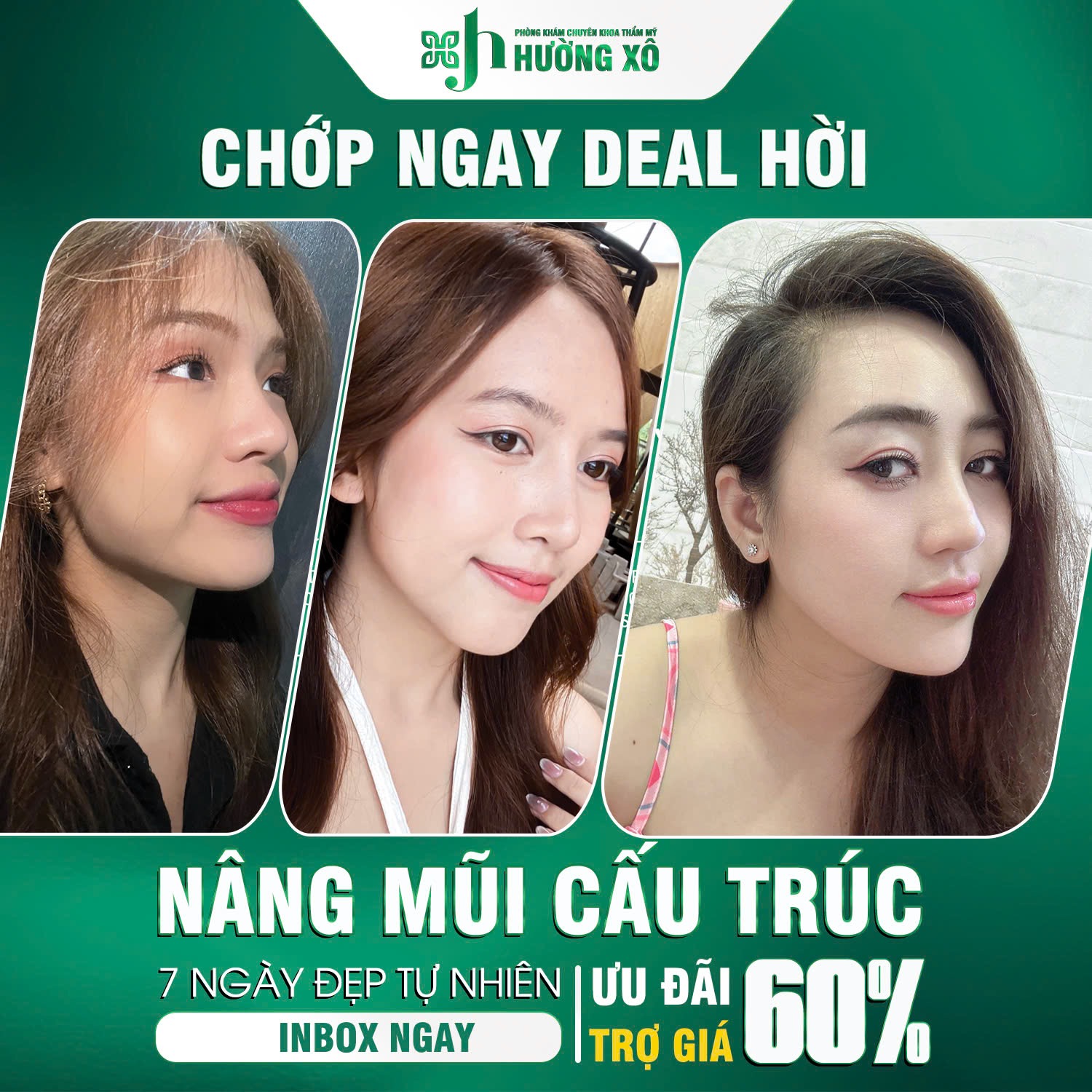 Nâng mũi cấu trúc