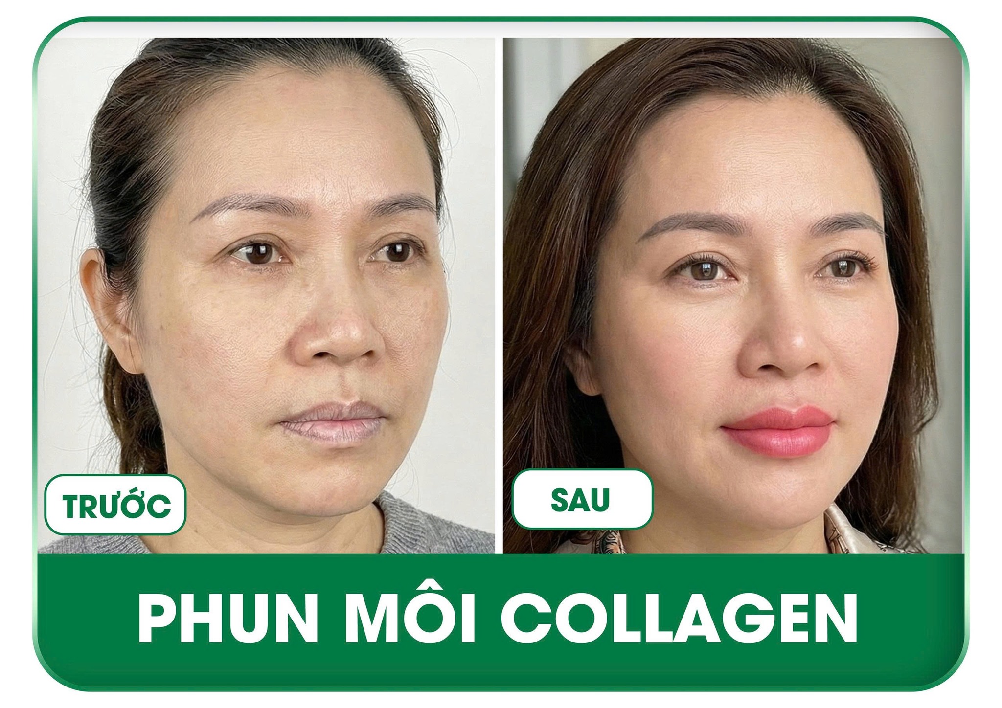 Phun môi collagen