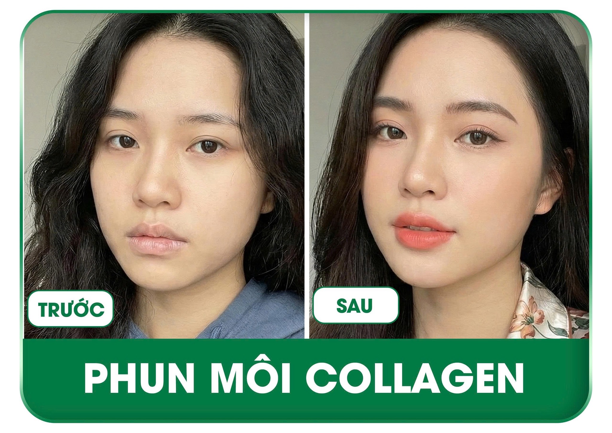 Phun môi collagen